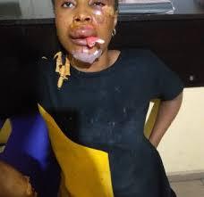 Woman Shot During Kidnap Attempt Recounts Terrifying Ordeal After Rescue in Ogun State